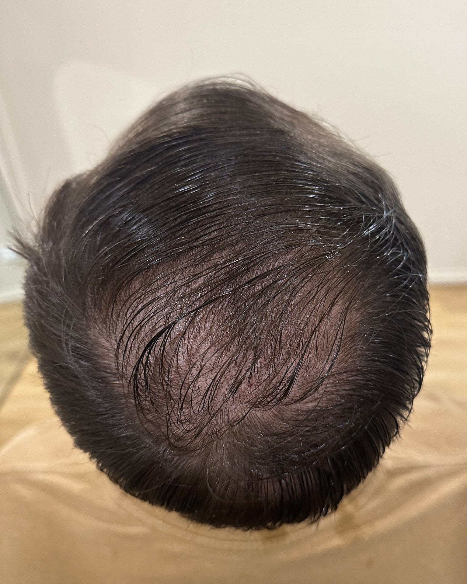 Male clients scalp after micro pigmentation tattooing