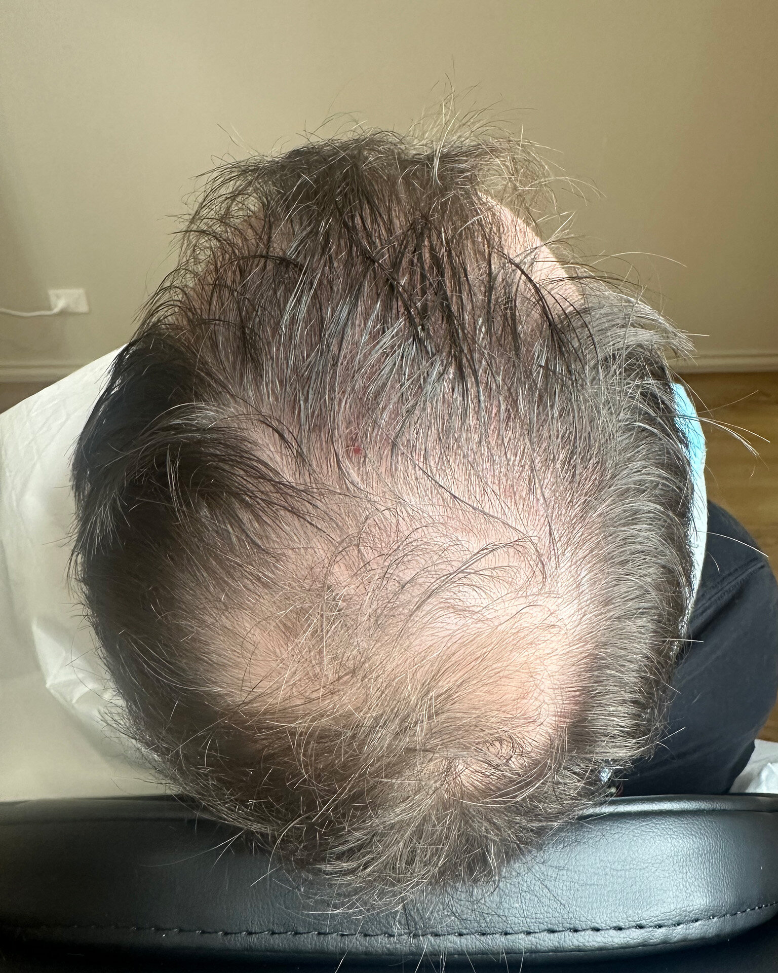 Male clients scalp before micro pigmentation tattooing