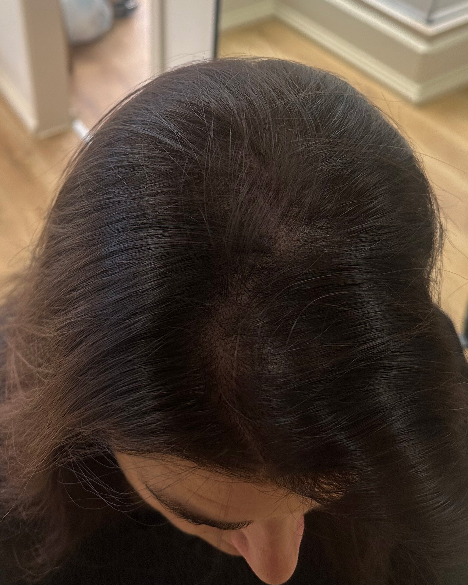 Female clients scalp after micro pigmentation tattooing