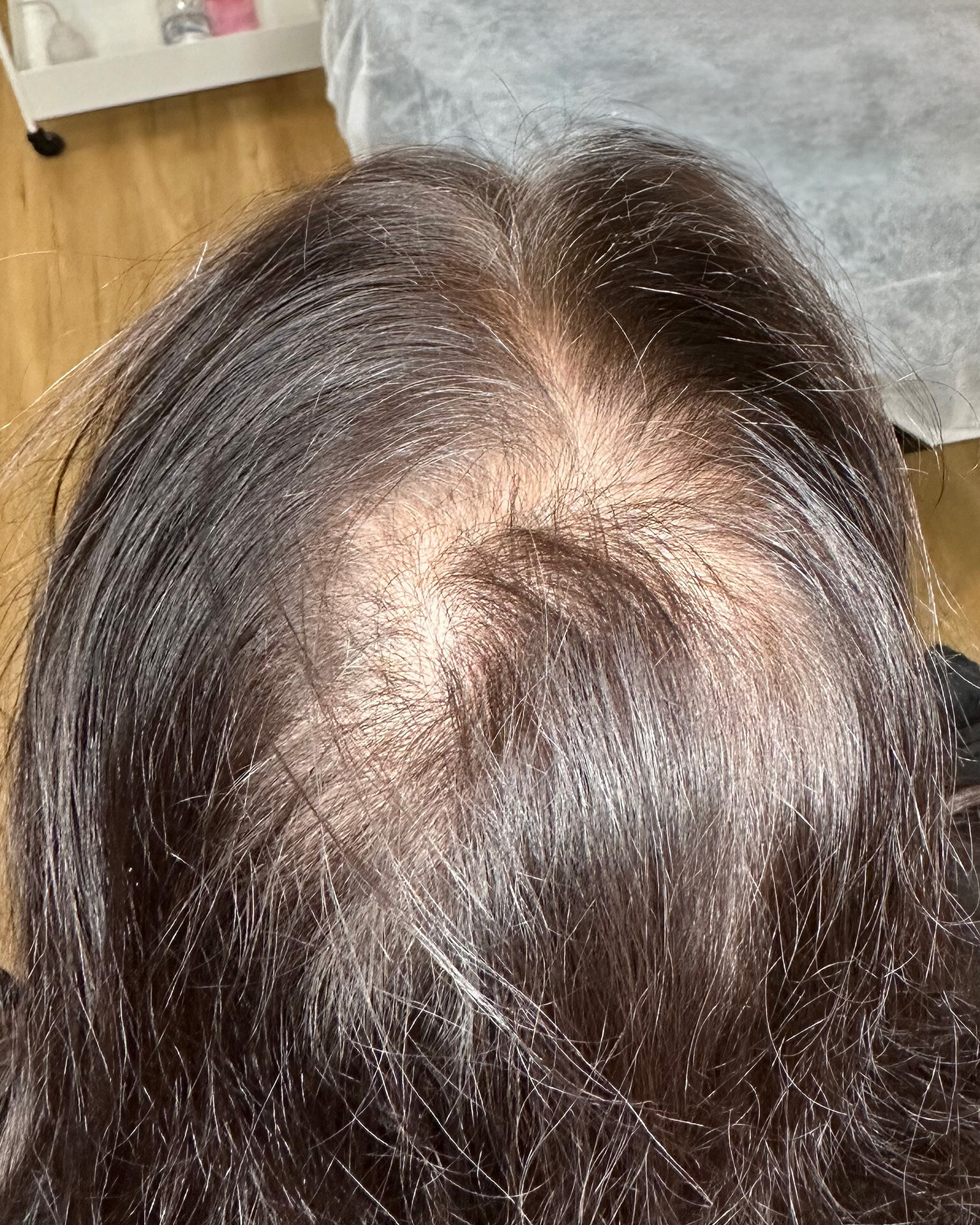 Female clients scalp before micro pigmentation tattooing