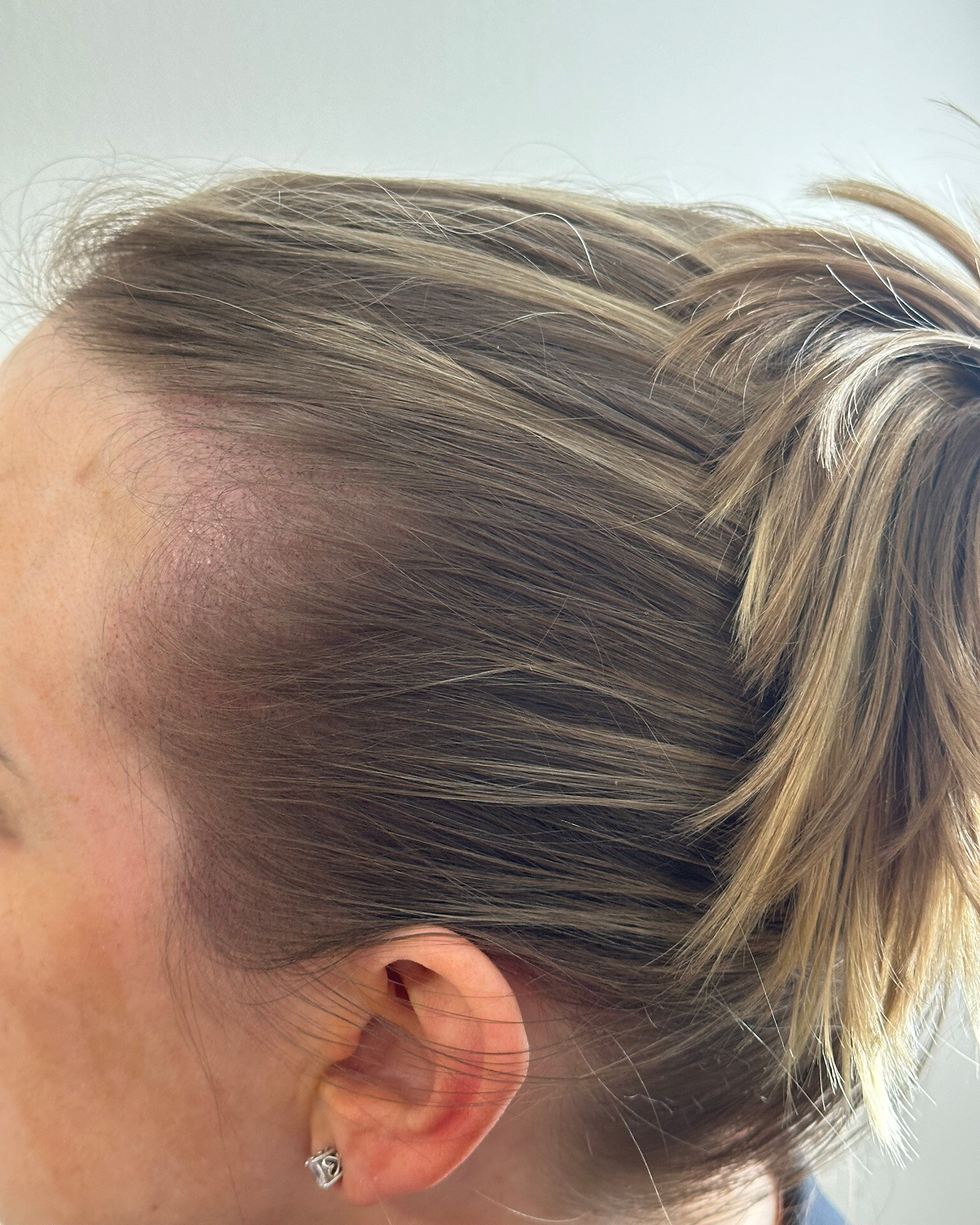 Female clients scalp after micro pigmentation tattooing